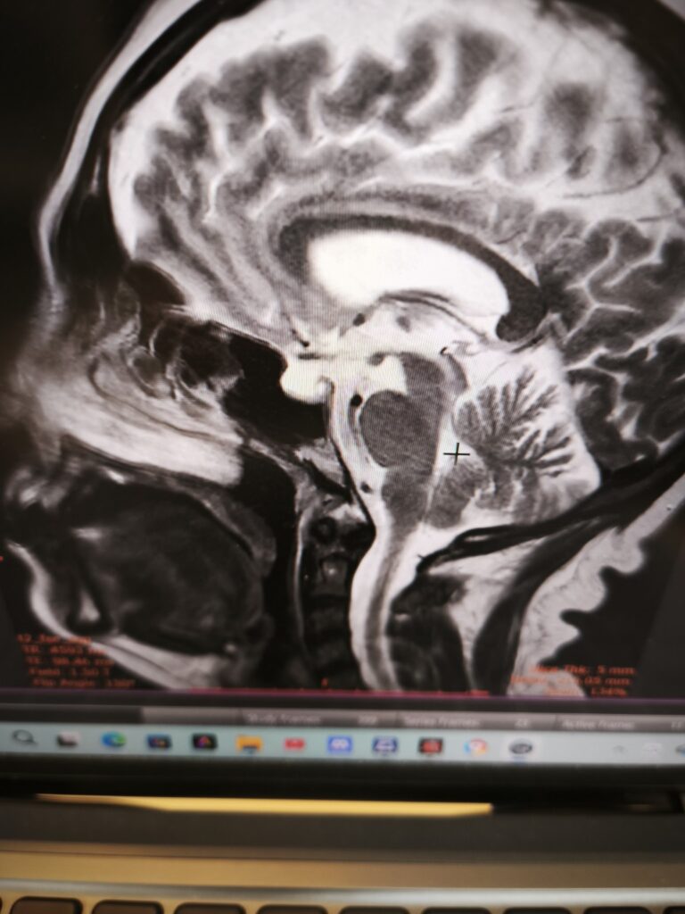 empty sella turcica syndrome